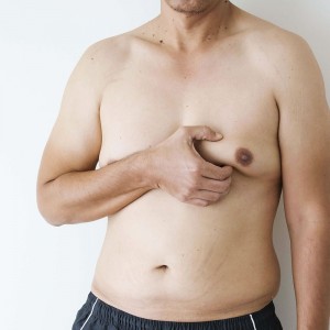 How to Tell if You Have Gynecomastia or Just Fat?